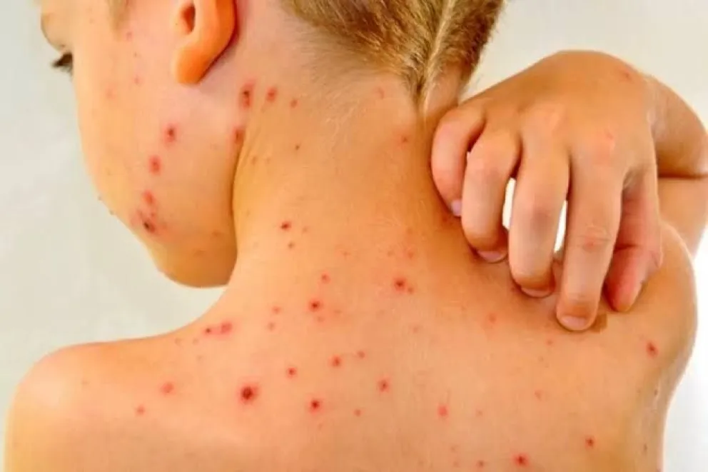 Alerta epidemiológica en Entre Ríos: Los casos de varicela aumentan en dos departamentos